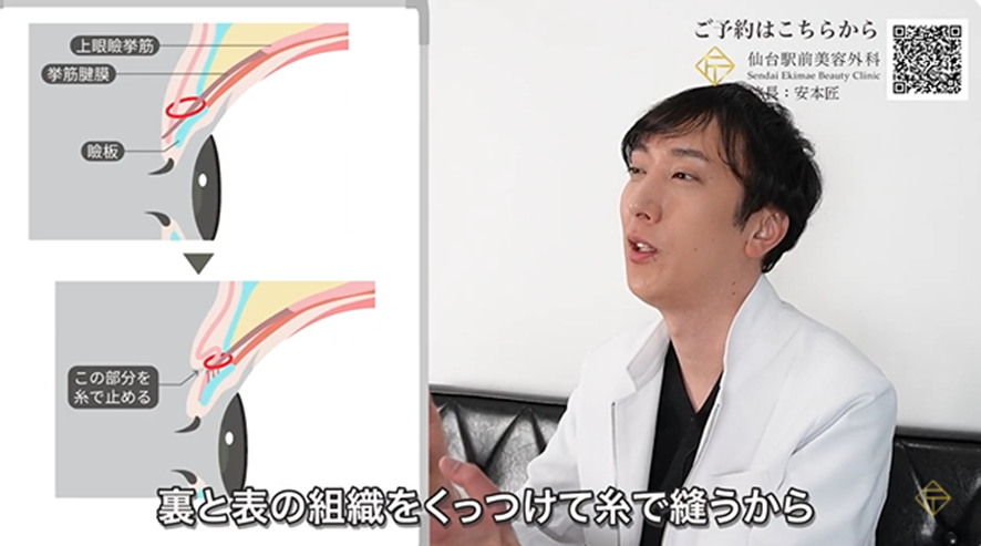 二重埋没法の二重ができる仕組み
