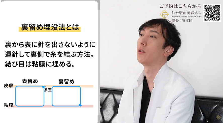 裏留め埋没法と表留め埋没法
