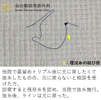他院で抜糸できていなかった糸