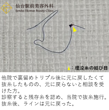 裏留めトリプルの抜糸