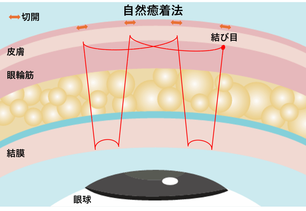 自然癒着法の縫い方