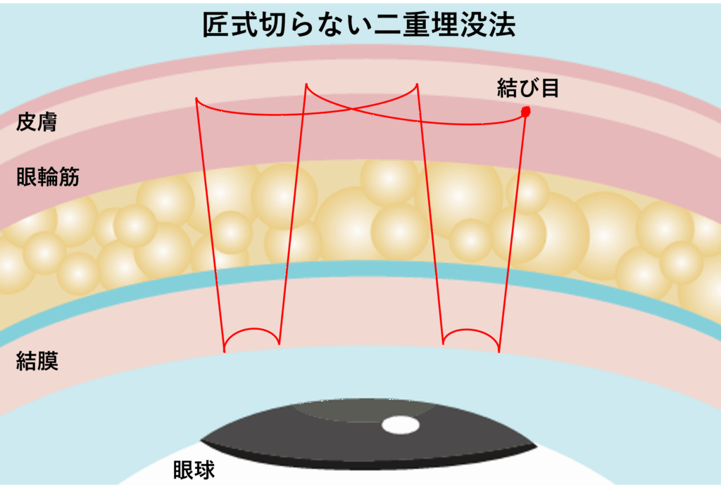 匠式切らない二重埋没法の縫い方