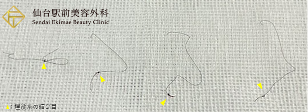 抜糸された埋没糸