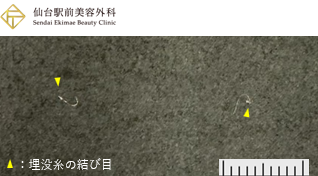 透明化した埋没糸