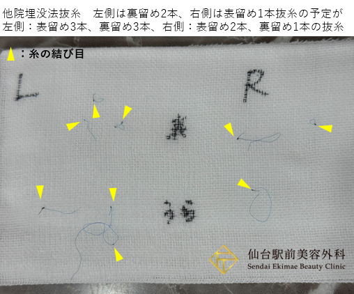 表留め、裏留めの抜糸