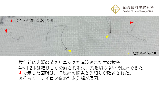 脱色・先細りした埋没糸