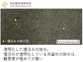透明化した埋没糸