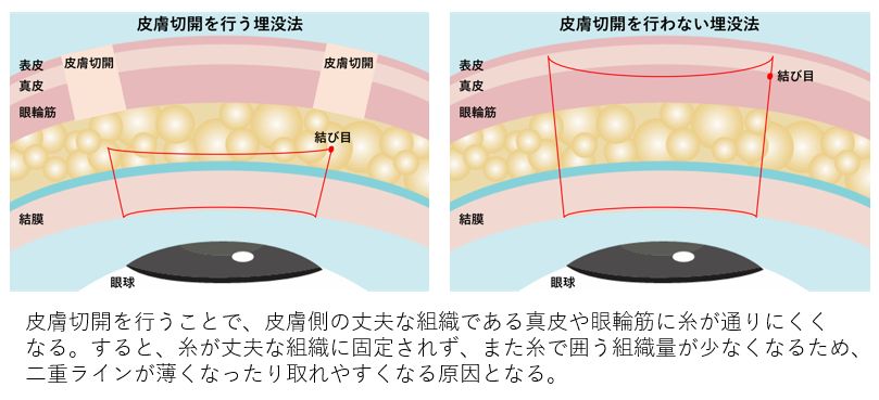 切開する埋没法と切開しない埋没法