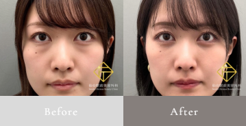 経結膜脱脂術症例写真