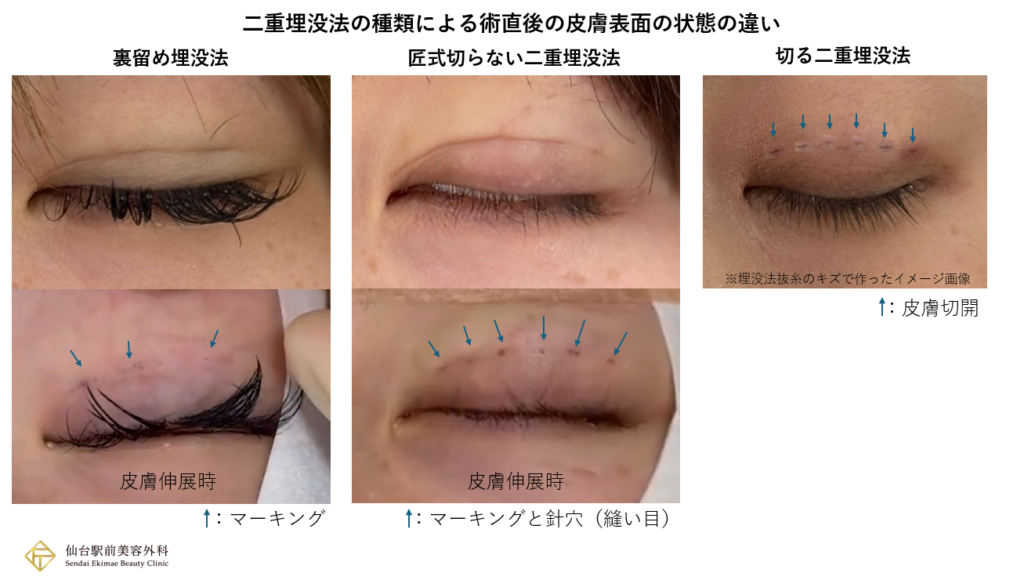 二重埋没法の種類による術直後の皮膚表面の状態の違い