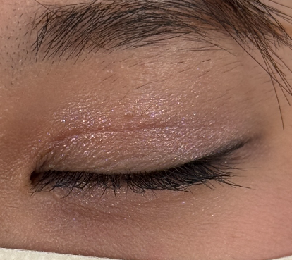 切開法御術後1ヶ月のキズ