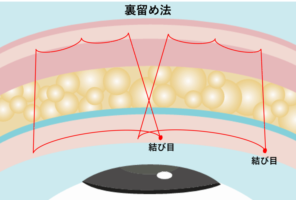 裏留め法の図