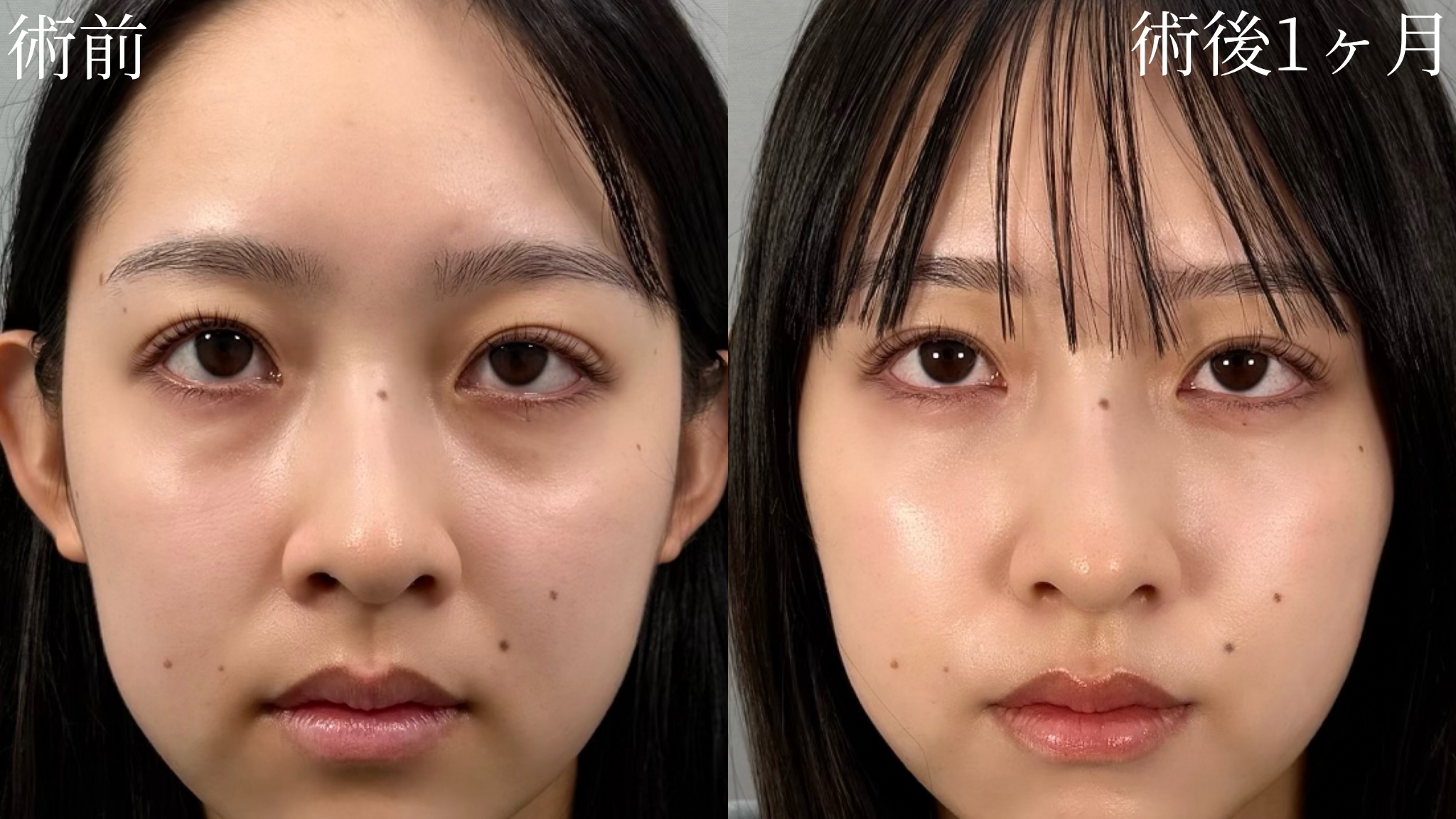 仙台駅前美容外科のクマ取り症例