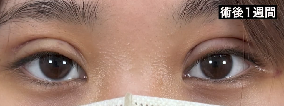 二重切開法術後1週間の状態