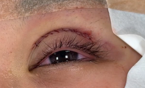 切開法直後の瞼の状態