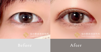 二重埋没法の前後写真