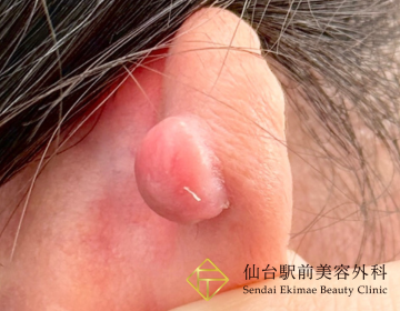 ピアスケロイド切除（Before）