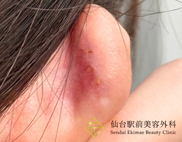 ピアスケロイド切除（After）