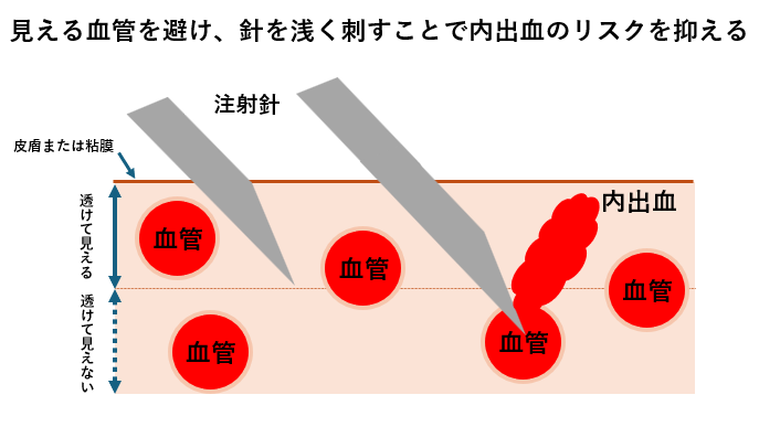 麻酔針の深さによる内出血のリスクの違い