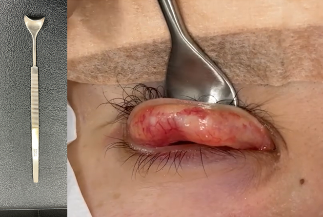 デマル鈎を用いた粘膜の観察