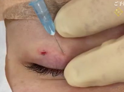 皮膚側への麻酔