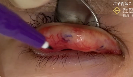 同定した結び目の箇所にマーキング