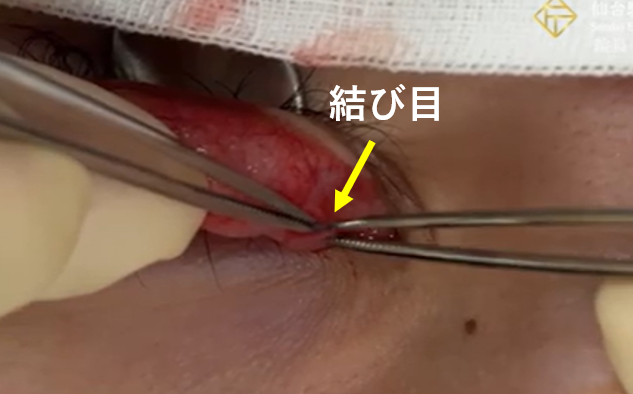 埋没糸(結び目)の剥離