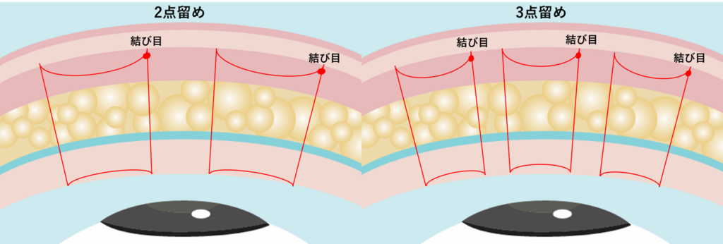 2点留めと3点留めの図