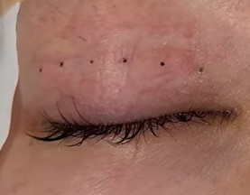 二重埋没法のマーキング