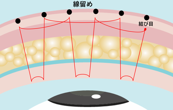 二重埋没法のマーキングのイラスト