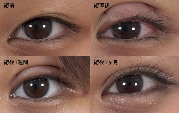 切開法のダウンタイムの経過