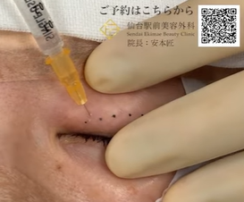 二重埋没法の皮膚側の麻酔