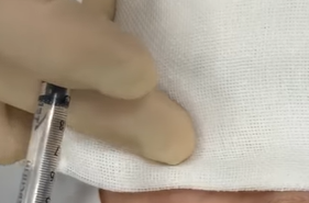 マーキングが消えないように麻酔の水滴をガーゼで吸い取る