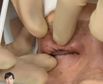 瞼のひっくり返し方