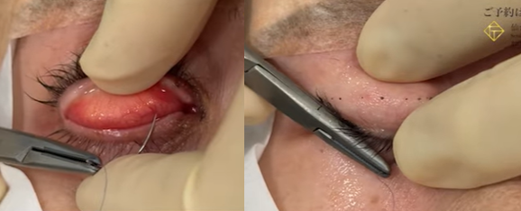 二重埋没法の運針のポイント