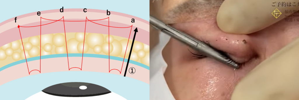 二重埋没法の運針