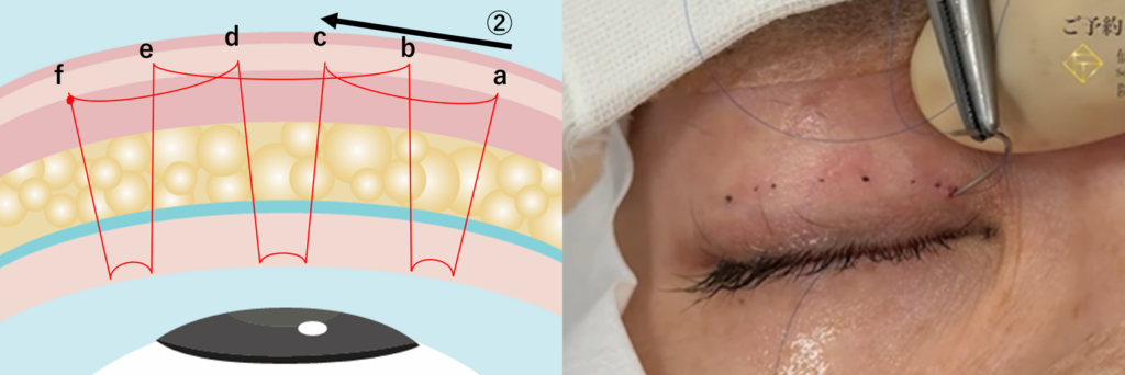 二重埋没法の運針