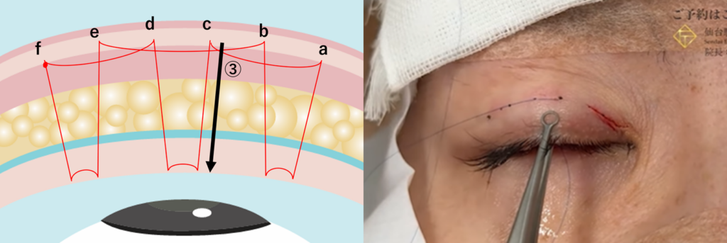 皮膚側からの運針