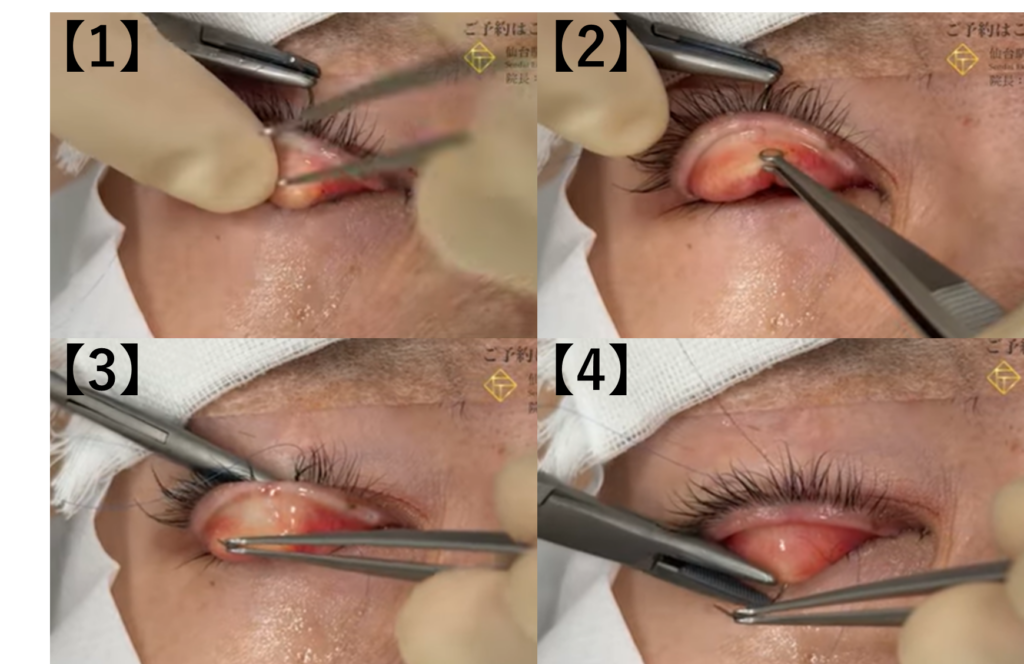 皮膚側から粘膜側への運針のポイント
