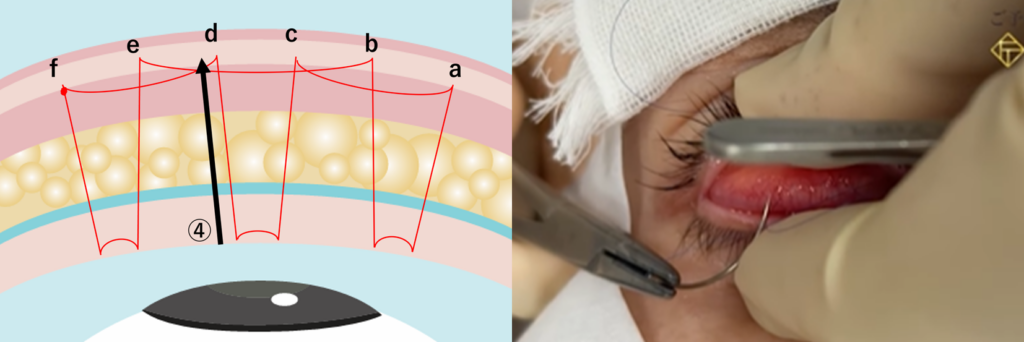 二重埋没法の運針