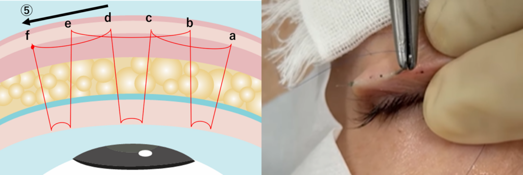 二重埋没法の運針