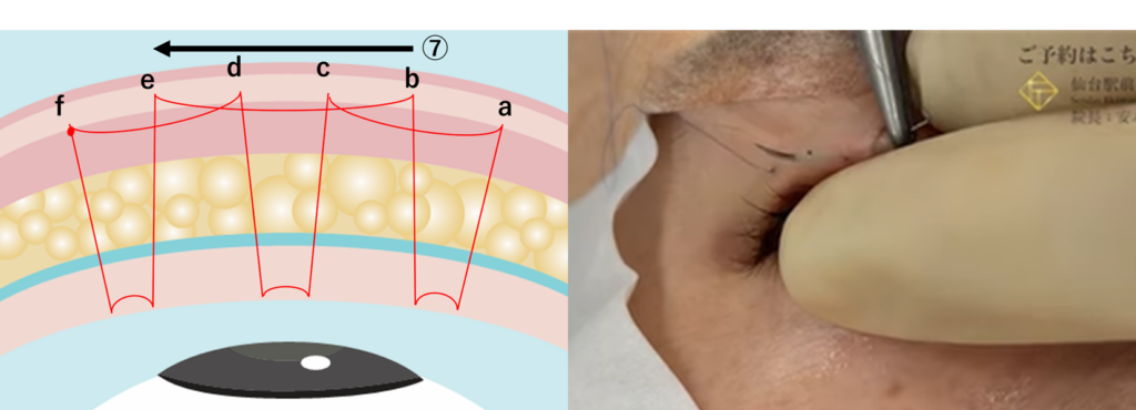 二重埋没法の運針