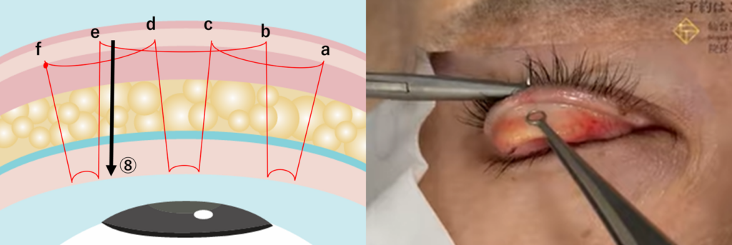 二重埋没法の運針