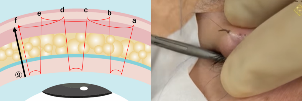二重埋没法の運針