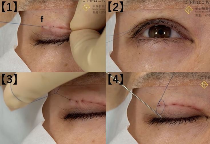 二重埋没法の糸の調整と結紮