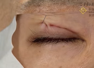 二重埋没法の結紮