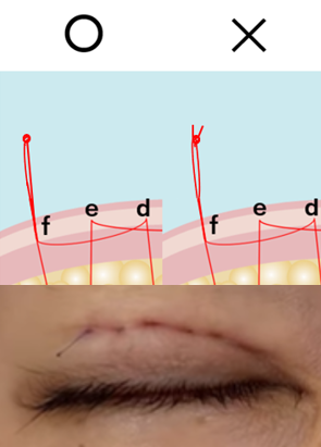 埋没糸のカットについて