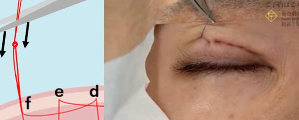 埋没糸のカット