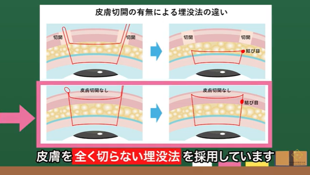 真皮に糸をしっかりかけるためには、皮膚を切らないことが重要