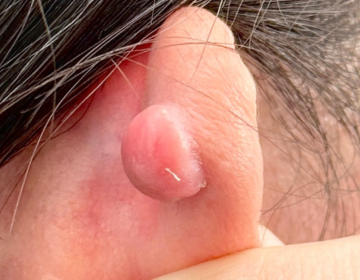 ピアスケロイド